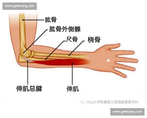 科学康复训练助力网球肘缓解与日常功能全面恢复指南实用方法解析 - 副本 - 副本